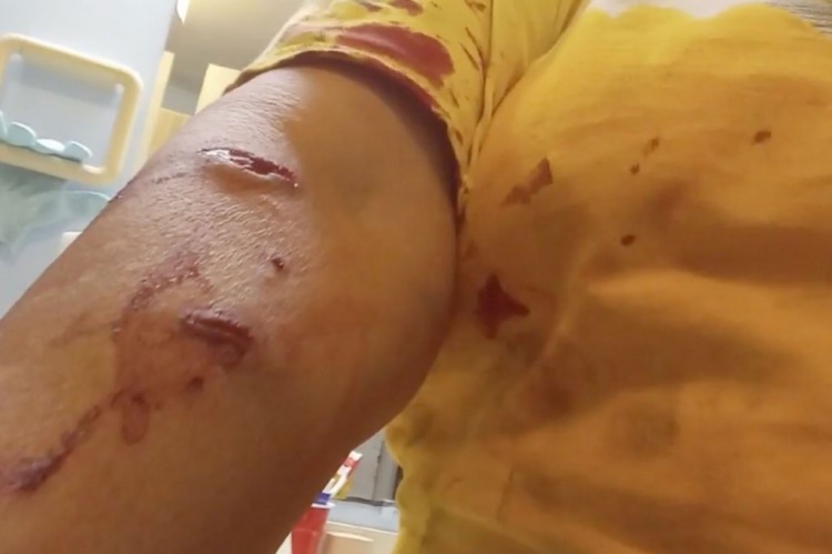 [艾略特]佛羅里達州婦女在拯救寵物羅威納犬免遭鱷魚襲擊時受傷